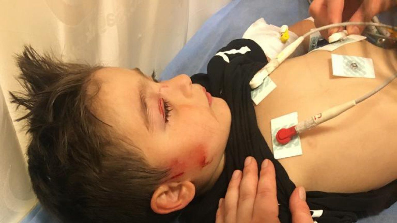 Köpeklerin saldırdığı 3 yaşındaki çocuğun yüzü parçalandı