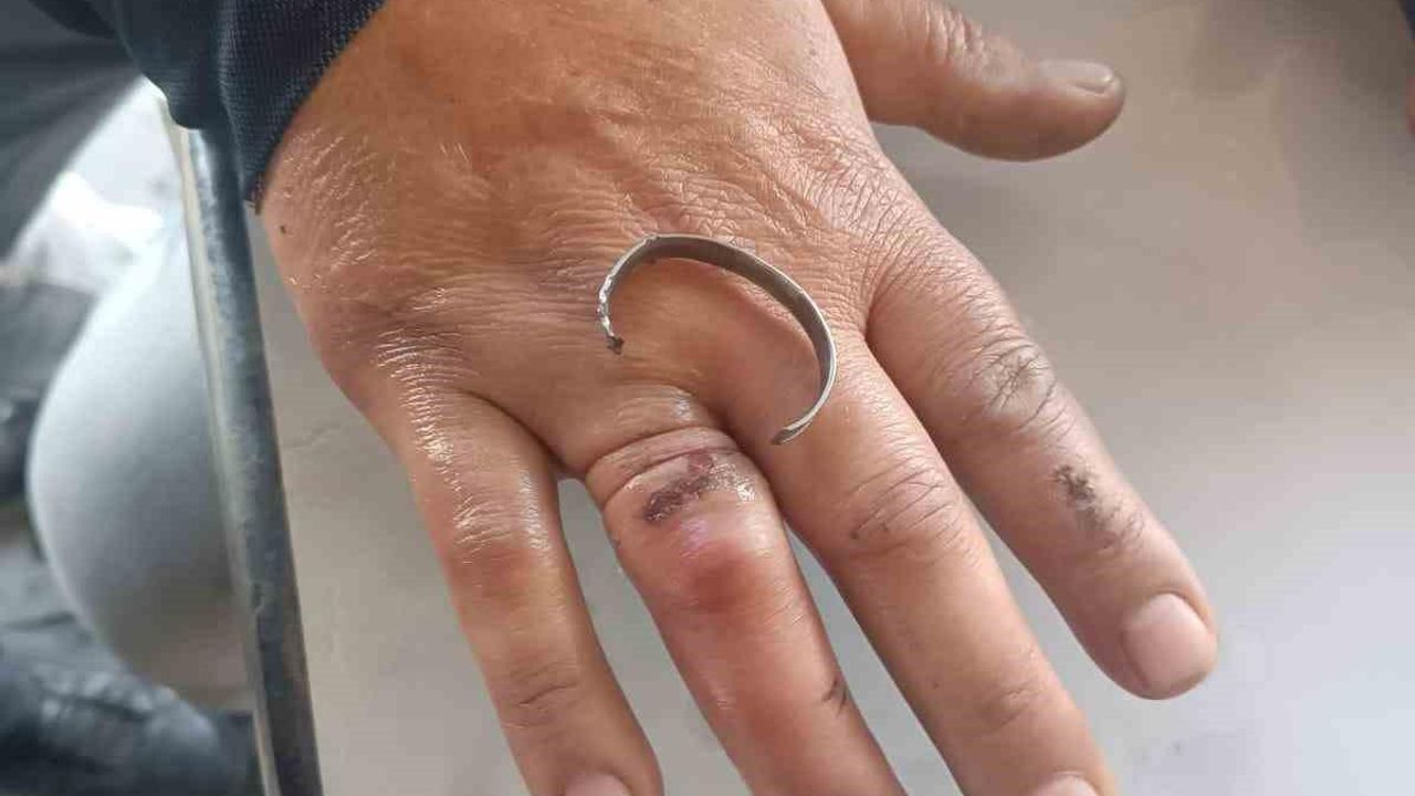 Parmağına sıkışan yüzüğü, itfaiye keserek çıkardı