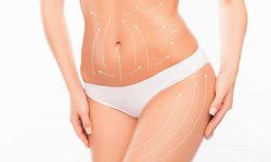 Liposuction (Yağ Aldırma) Tedavisi
