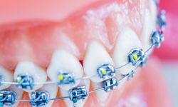 Diş Teli Tedavisi Almak İsteyenlere Verilebilecek Öneriler