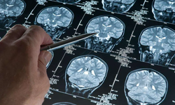 Alzheimer riskini artıran genetik varyant bulundu