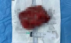 Van’da kalbin üzerinden 2 kiloluk kitle çıkarıldı