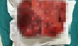 Göğsünden  3 kilogramlık tümör çıktı