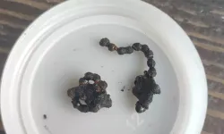 5 Yaşındaki Çocuğun Burnunda 2 Yıldır Zincir Olduğu Fark Edildi