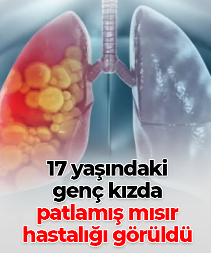 17 yaşındaki  genç kızda  patlamış mısır hastalığı görüldü