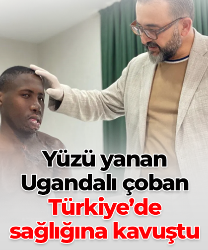 Yüzü yanan Ugandalı çoban Türkiye’de sağlığına kavuştu