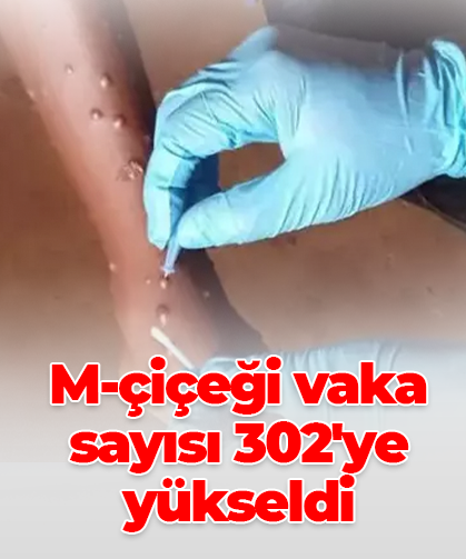 M-çiçeği vaka sayısı 302'ye yükseldi