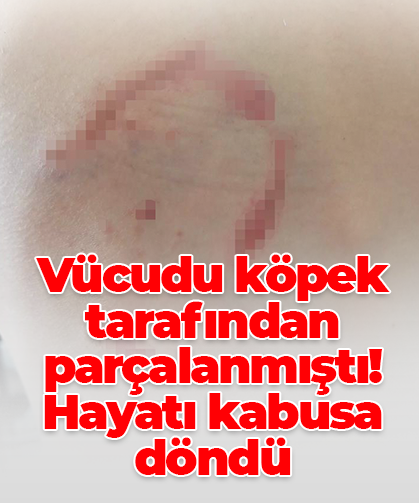 Vücudu köpek tarafından parçalanmıştı! Hayatı kabusa döndü
