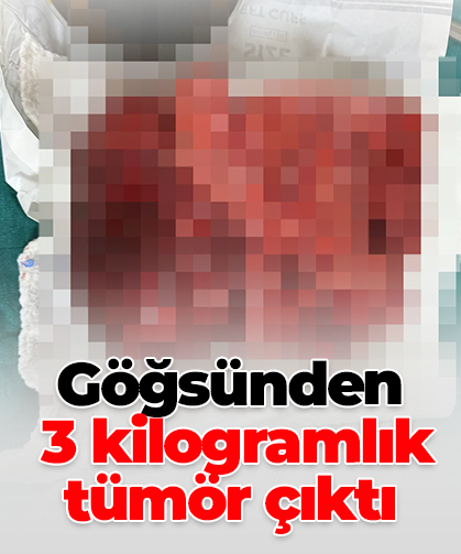 Göğsünden  3 kilogramlık tümör çıktı