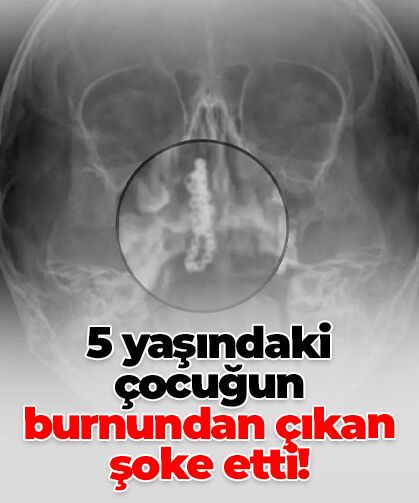 5 Yaşındaki Çocuğun Burnunda 2 Yıldır Zincir Olduğu Fark Edildi
