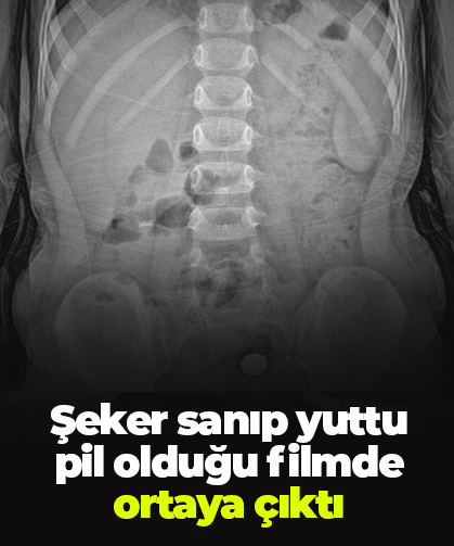 Şeker sanıp yuttu pil olduğu filmde ortaya çıktı