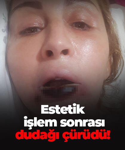 Estetik işlem sonrası dudağı çürüdü!