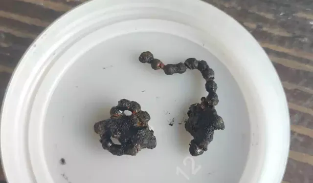 5 Yaşındaki Çocuğun Burnunda 2 Yıldır Zincir Olduğu Fark Edildi