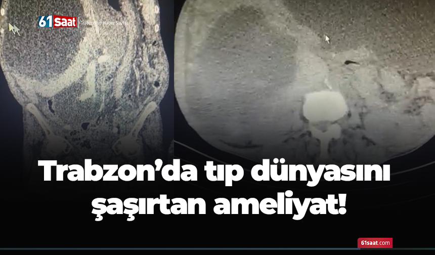 Trabzon'da tıp dünyasını şaşırtan ameliyat