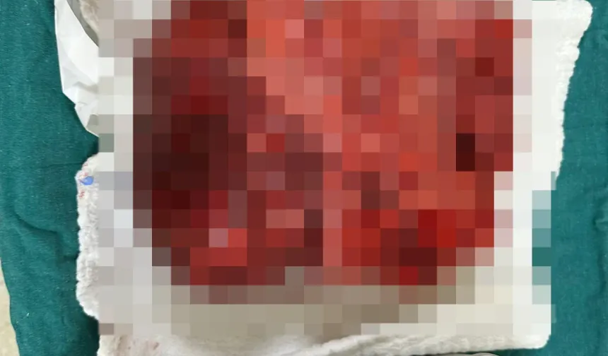 Göğsünden  3 kilogramlık tümör çıktı